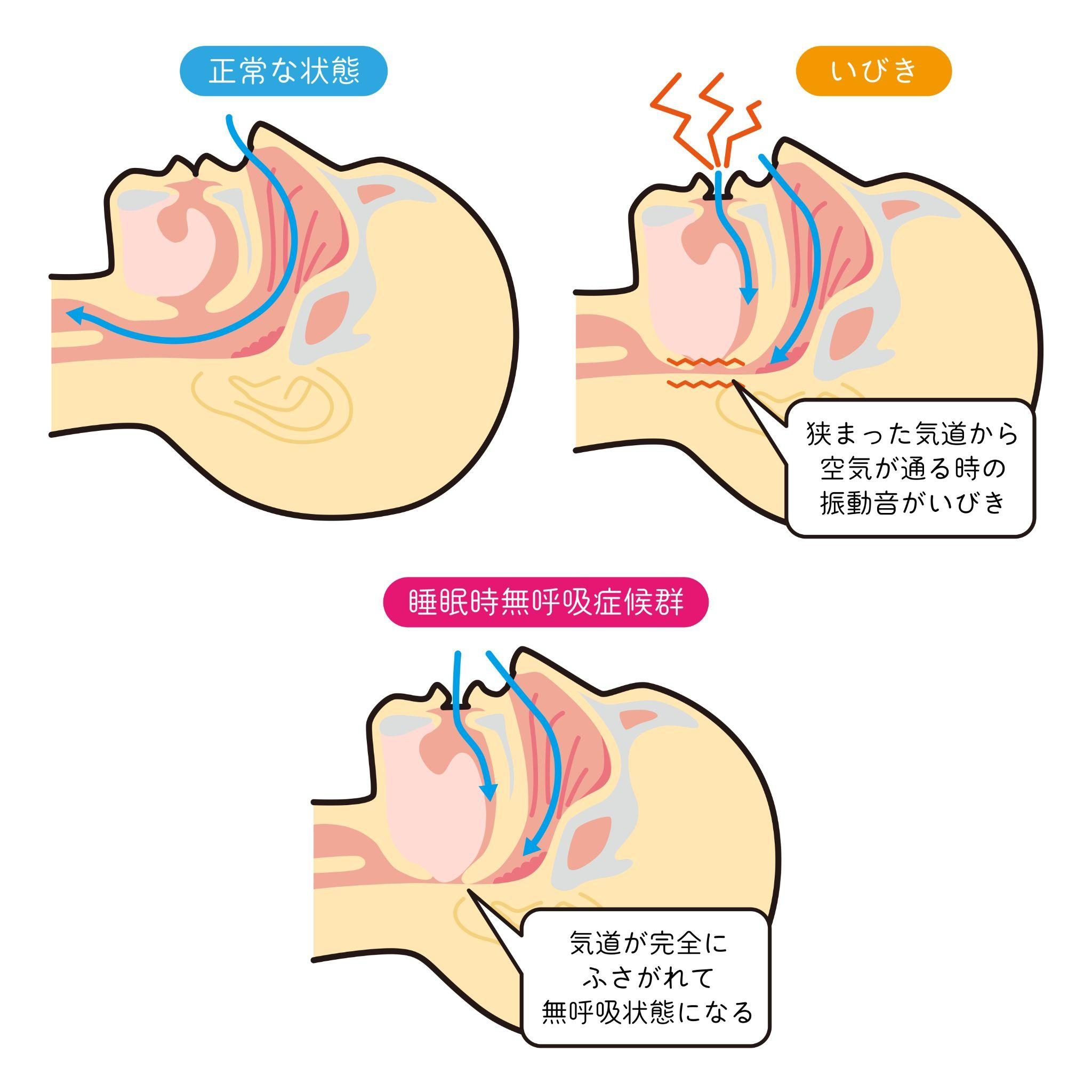 睡眠時無呼吸症候群（SAS）とは？